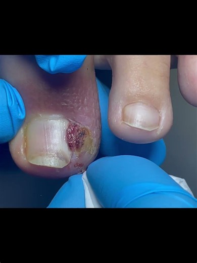 Wow, be careful when treating ingrown toenails. #pedicure #satisfying
