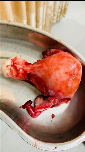 TAH–BSO(Total Abdominal Hysterectomy with Bilateral Salpingo-Oophorectomy) Surgery🩸| #shorts #viral