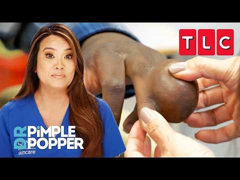 Most Mysterious Conditions | Dr. Pimple Popper | TLC