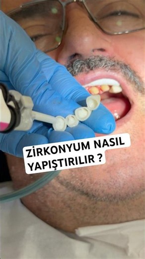Zirkonyum kaplama #fypシ #orthodontist #dentalartistry #smiledesigndental #dentist