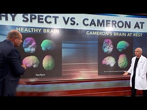 Psychiatrist Analyzes Brain Scans Of 21-Year-Old With Anger And Drug Issues