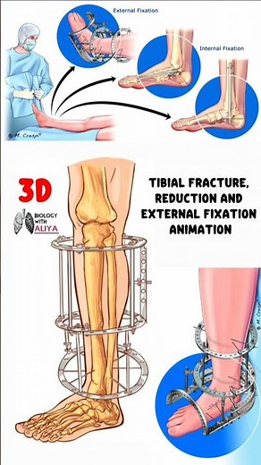 Tibial Fracture, Reduction and External Fixation Animation #medical #animation #3d #short