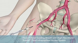 Flexor® - 血管アクセス シース by COOK Medical | MedicalExpo