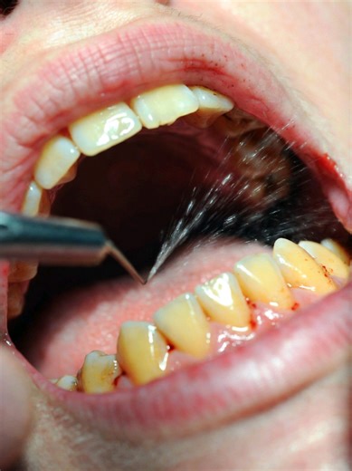 Deep Dental Restoration: From Decay to Digital Perfection