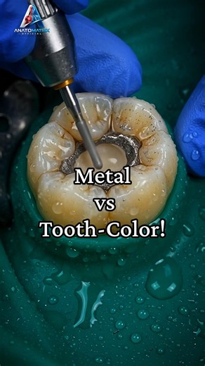 How Dentists Replace Old Metal Fillings (Step-by-Step Restoration)#ASMR #dental #dentist