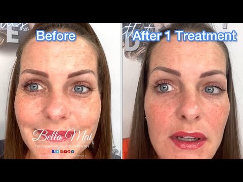 Derma 2 Bio, Full Face Skin Rejuvenation - Before, During, After & 2 Week Healing Process