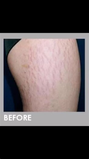 CO₂ Laser stretch mark treatment ✨ Before & after results. Designed to resurface the skin and boost collagen for smoother-looking skin. Results continue to improve with time. 📍 Free consultation available #co2 #co2laser #stretchmarksbegone #stretchmarks #surreyclinic #agelessbeauty | Ageless Beauty Laser & Spa