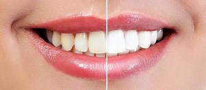 10 alimentos para não comer após clareamento | BRdental