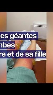 Des cloques géantes apparaissent sur les jambes d’une mère et de sa fille après une sortie au lac