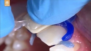 74K views · 474 reactions | Lindo caso de cierre de diastema por el Dr. Robert Lowe, con el auxilio del sistema de plantillas #Uveneer y el nuevo láser de diodo #Gemini de Ultradent. Link para el video completo: https://youtu.be/1JedZ6UXh98 | Ultradent Latinoamérica | Facebook