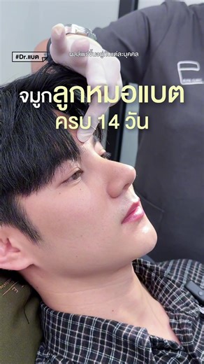 ครบ 14 วันกับทรงจมูกที่หล่อราวเทพบุตร 😍🥰 #หมอแบต #อีลิทคลินิก #เสริมจมูกผู้ชาย #เสริมจมูก #eliteclinic @Eliteclinic