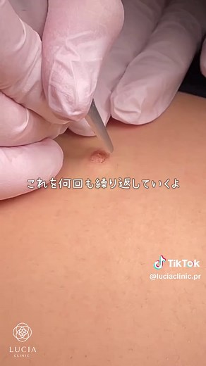 丁寧なホクロ除去施術：跡を残さない施術方法