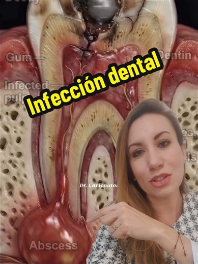 ☠🦷 Si notas tus dientes con caries o tienes dolor, no esperes mas y acude a consulta con tu Dra. Sonrisas. 📲 Citas 6861613929 #caries #endodoncia #infeccióndental #drasonrisas