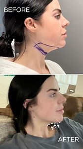 AirSculpt on Instagram: "With minimal bruising and instant results that have gotten better by the day, @randiibates is thrilled with her newly chiseled chin and seamless recovery process. “I had a great experience with the AirSculpt. It was super easy, quick, and painless. The recovery has been so easy, and my results are already looking so great & I’m only a week post-op. I can’t wait to see the full result. I would recommend this to my family, friends or anyone that is considering AirSculpt. I