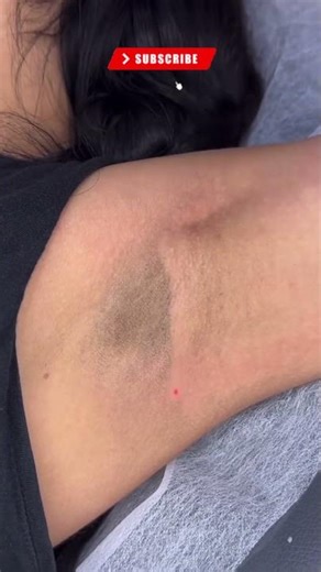 Laser Intimate Whitening | Even Skin Tone & Confidence