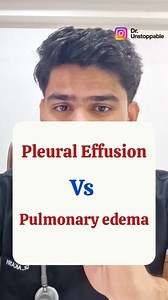 Dr Unstoppable | Medical Educator | Health Creator on Instagram: "Pleural Effusion vs Pulmonary Edema ! #medicalreels #futuredoctor #doctorexplains #medicaleducation #doctorcontent Doctor, Medical student, Future Doctor, wannabe Doctor"