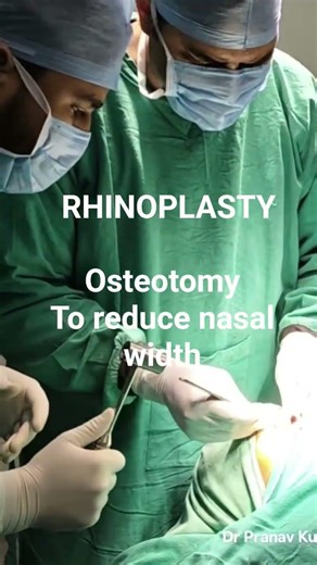 RHINOPLASTY- Osteotomy to reduce Nasal width- Dr Pranav Kumar, Plastic Surgeon, Bihar