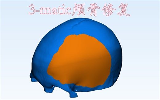 Mimics、3-matic颅骨修复、假体设计标准教程1