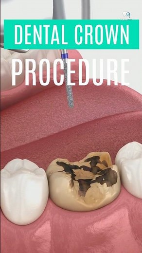DENTAL CROWN PROCEDURE #shorts