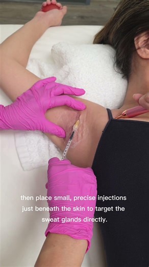 Struggling with excessive underarm sweating?Botox for hyperhidrosis may be the solution.