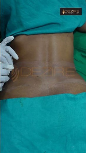Lower Back Liposuction result | Dressing removal