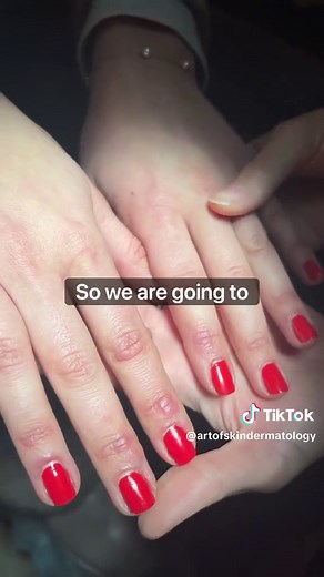 Understanding Chilblains: Symptoms and Treatment Options