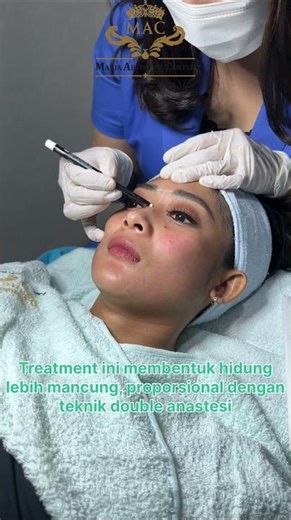 nose threadliftt