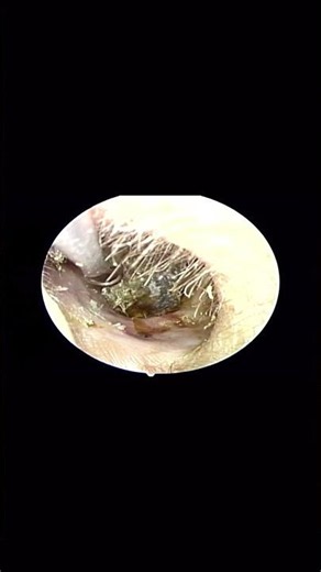 Complete Ear Health Check 😳 | Detecting Hidden Ear Problems #entclinic #health #shorts