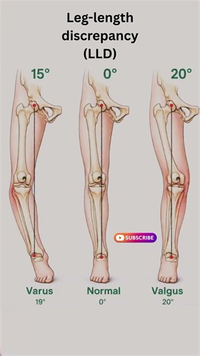 Leg length discrepancy LLD