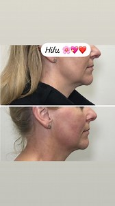 Le HIFU (High-Intensity Focused Ultrasound) est une technologie de lifting non chirurgicale qui utilise des ultrasons focalisés de haute intensité pour raffermir et lifter la peau. Il agit en chauffant les couches profondes de la peau (jusqu’au SMAS, la même couche ciblée lors d’un lifting chirurgical), stimulant ainsi la production de collagène et d’élastine. Avantages du HIFU : ✔️ Effet lifting naturel et progressif ✔️ Non invasif, sans chirurgie ni aiguilles ✔️ Résultats visibles après quelqu