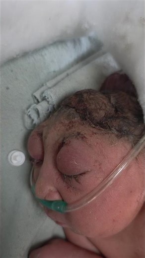 Anencephaly with encephalocele#mbbs#pediatrics