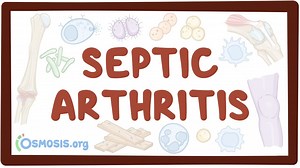 Septic arthritis: Video, Causes, & Meaning | Osmosis