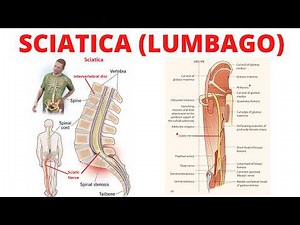 “Sciatica Explained: Causes, Symptoms and Best Treatment Options | Complete Guide”