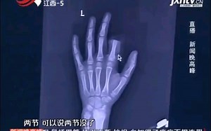 不做作业玩手机挨骂，男孩赌气挥刀剁手，父亲后悔不已