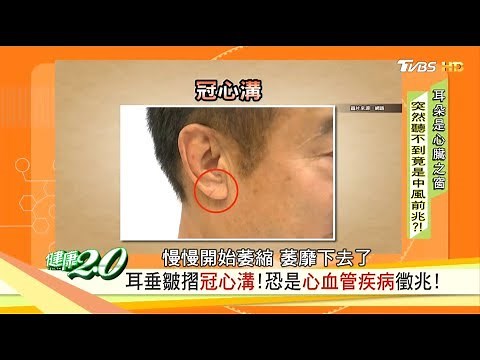 快檢查！耳垂出現這條「皺褶冠心溝」恐是心血管疾病徵兆！健康2.0