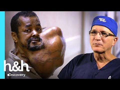 Médicos remueven inmenso bulto en su cuello | Mi cuerpo, mi desafío | Discovery H&H