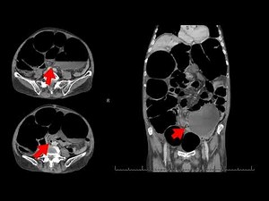 Endoscopic intervention is a minimally invasive approach for managing sigmoid volvulus