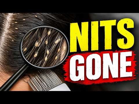 How to Remove Nits from Hair Permanently | 100% Working Method 😱
