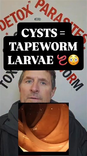 Ricky on Instagram: "What Is Hydatid Disease? Hydatid disease (also called cystic echinococcosis) is a parasitic infection caused by the tapeworm Echinococcus. Instead of living in the intestines like typical tapeworms, this one forms slow-growing cysts inside major organs — especially the liver and lungs. These cysts can grow for years without symptoms, which is why so many people have no idea they even have them. ⚠️ Why it’s so shocking Hydatid cysts can: • grow large • hold thousands of tapew