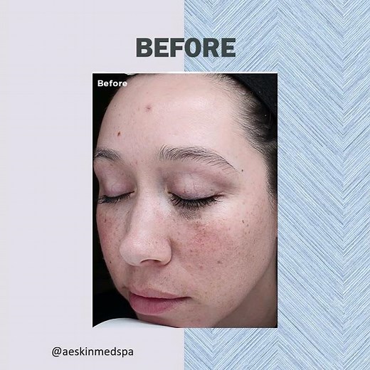 What VI Peel actually does to your skin #results #beforeandafter #aesthetic