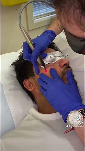 Laser Mole Removal | Face Mole Removal Treatment | Nitai Cosmetics Melbourne