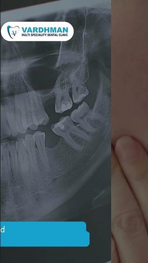 Wisdom Tooth Pain? 🦷 Causes, Symptoms & Treatment Explained #dentist #dentalcare #drdeepakjain #fyp