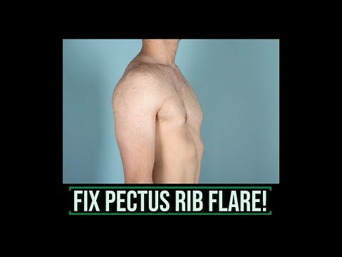 Fix Pectus Excavatum Rib Flare!