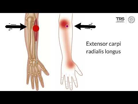 Tennis Elbow Trigger Points | Wrist Extensors