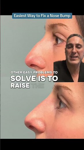 Easiest Way to Fix a Nose Bump