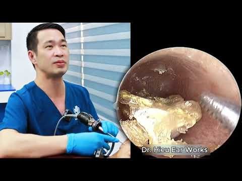 Deep infection debris removed reopening the ear pa | ear cleaning | ASMR earwax | soothing |relax|