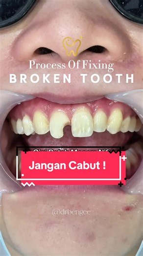 How to Fix a Broken Tooth Without Extraction