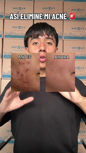 Si tú también estás luchando contra el acné te comparto esta solución 😊✅ #acne #alphabalance #desintoxicacion #jugoverde