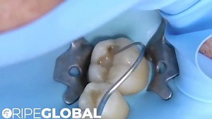12K views · 82 reactions | This is a video of the recently shown quadrant dentistry photos. It's in super high speed so you can watch the whole process. I'll edit and voicover the long version and put it on www.ripeglobal.com soon. In the mean time, hope you enjoy. Please ask questions if you see something that interests you and feel free to share. | RipeGlobal | Facebook