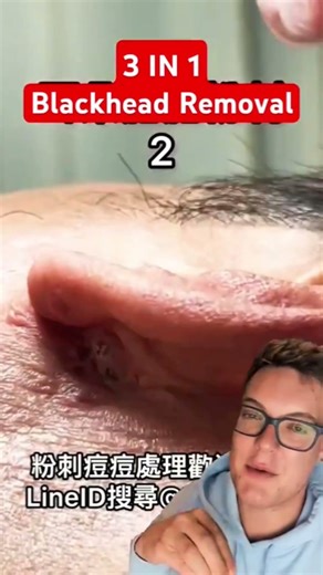 Worlds Biggest BLACKHEAD REMOVAL - 3 in 1 Blackhead #shorts